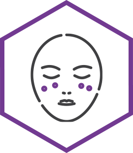 Melasma